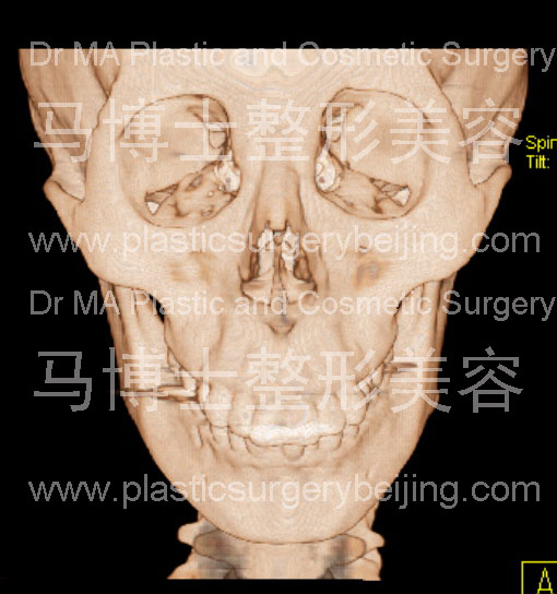 脸型瘦小者的颌面骨骼形状正面