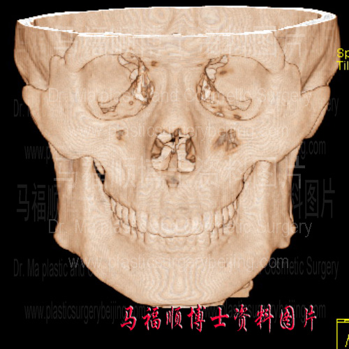 坡度陡的鼻骨三维CT