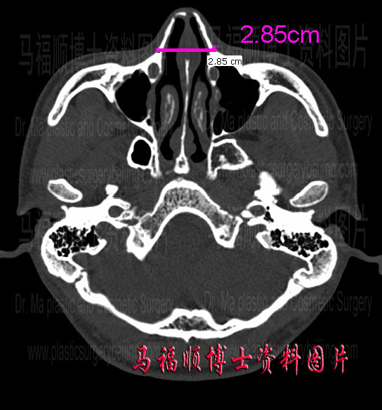 鼻骨正常CT图片图片