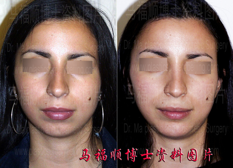 驼峰鼻整形手术前后