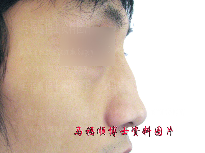 磨骨后鼻骨骨膜增生