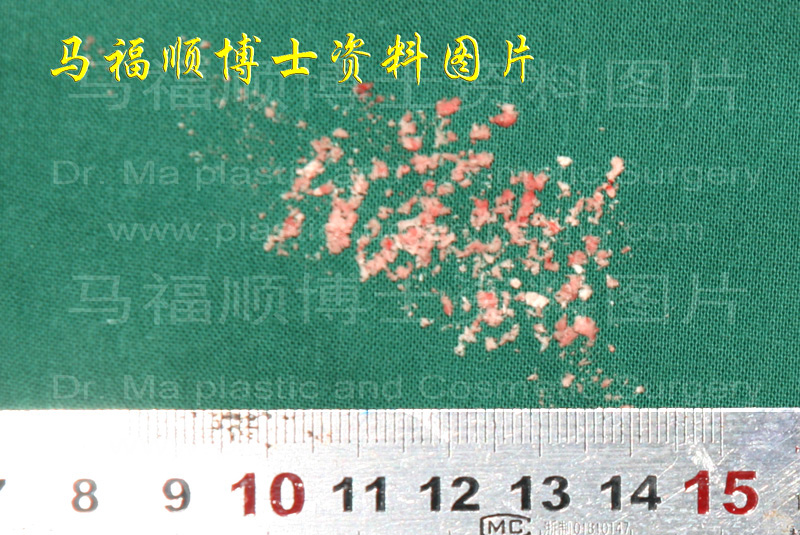 低速磨骨工具磨下的骨骼碎末