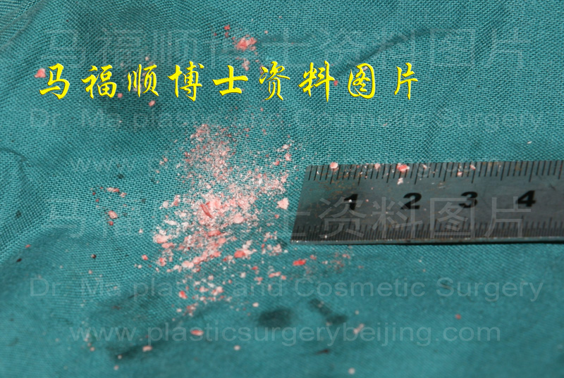 手动磨骨磨下的骨骼碎末