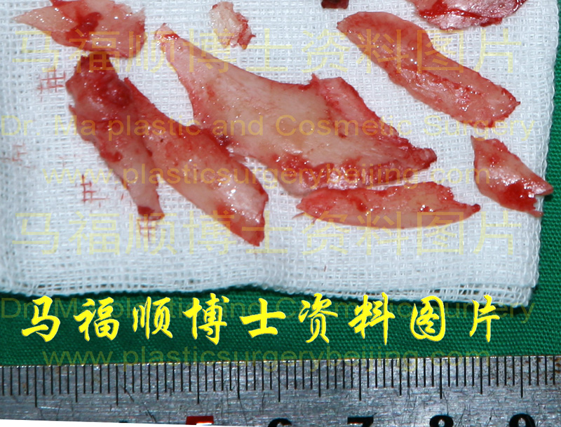 截骨所切下来的骨骼块