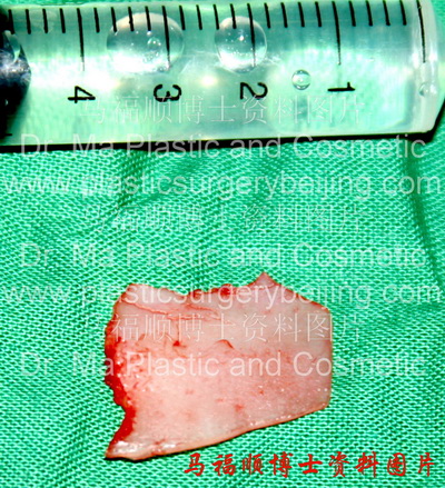 用于鼻延长的鼻中隔软骨