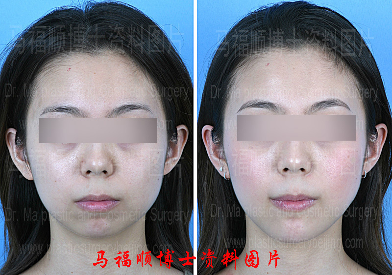 颏前移整形术前及术后