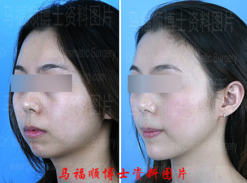颏前移整形对比照片斜位
