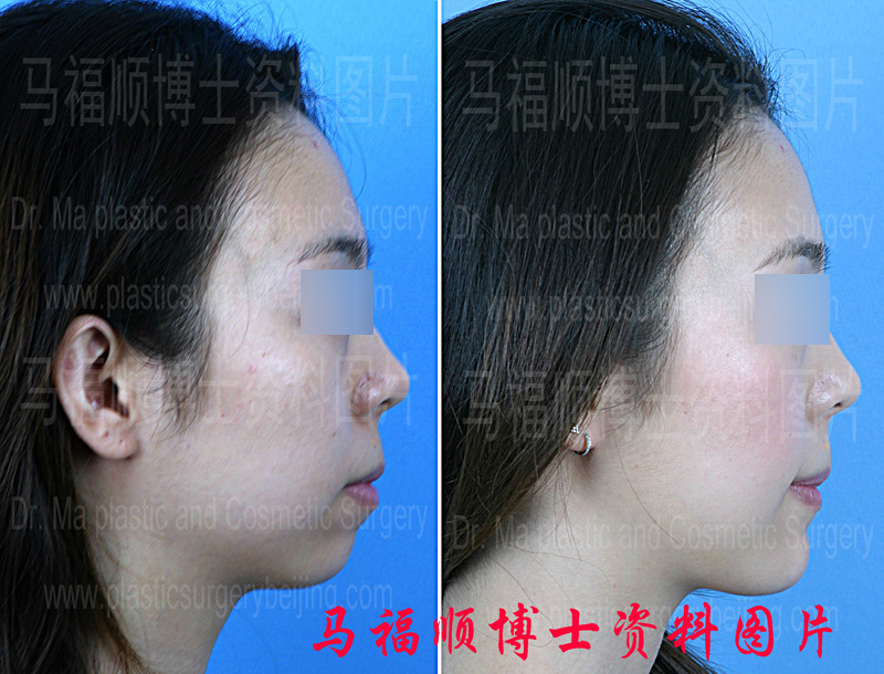 颏前移整形对比照片侧位