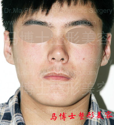 下颌角及颏成形术前