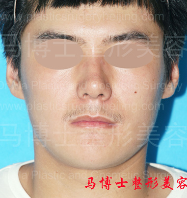 下颌角及颏成形术后