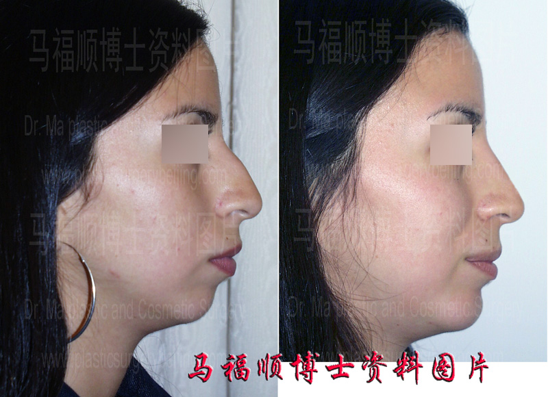 驼峰鼻整形手术前后