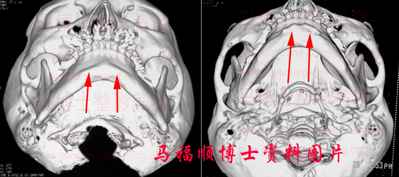 自体骨隆下巴颏