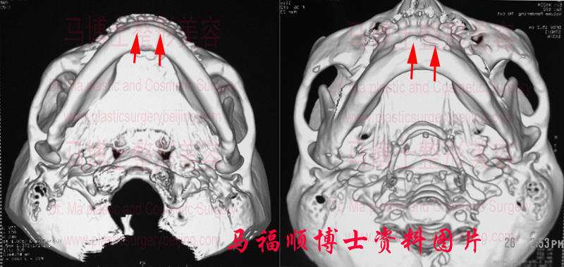 自体骨隆下颏仰头位
