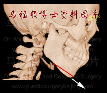 颏前移的截骨线及移动方向