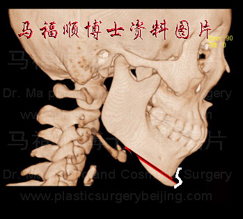 颏骨前移后固定