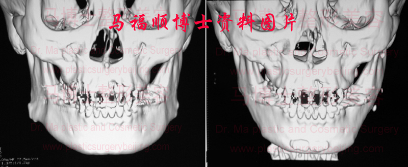 自体骨隆下巴颏术前及术后CT