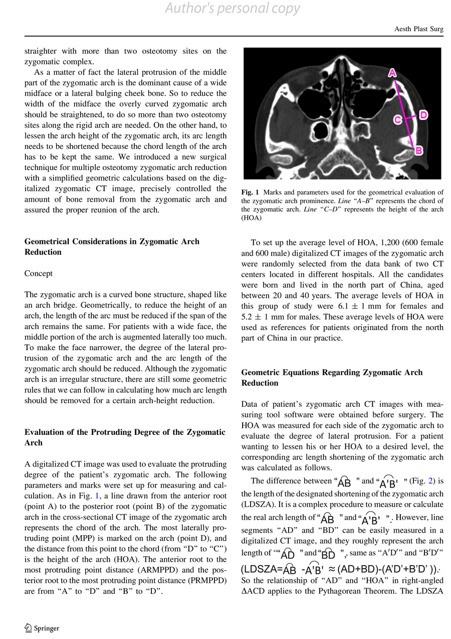 zygomatic arch reduction 2