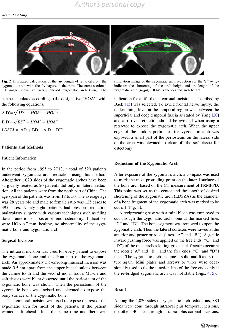 zygomatic arch reduction 3