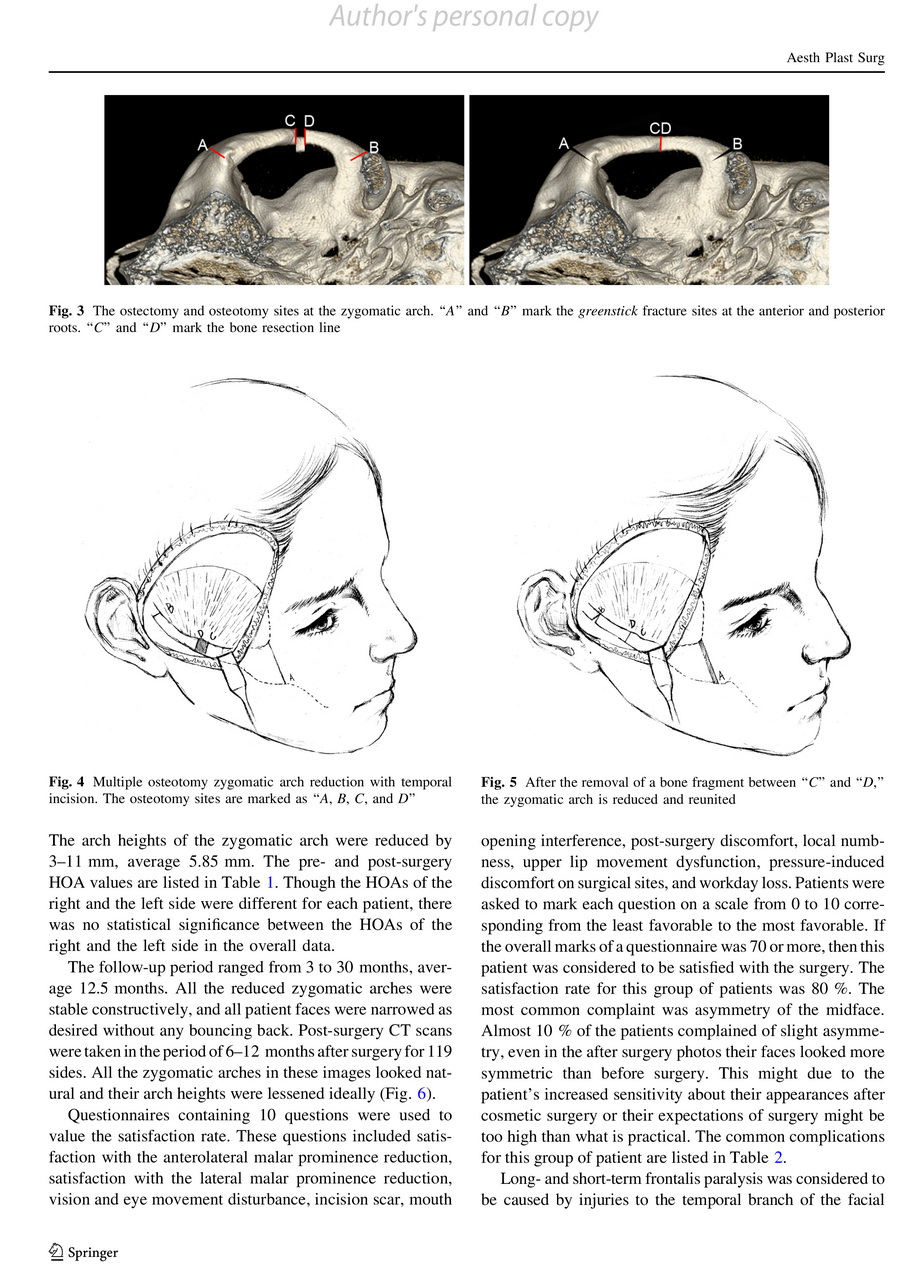 zygomatic arch reduction 4