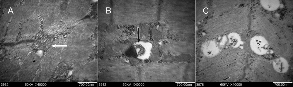 人咬肌肉毒素后