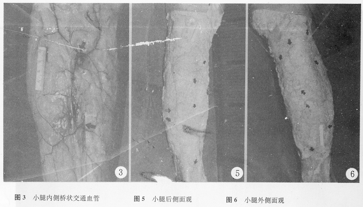 小腿皮动脉及其吻合