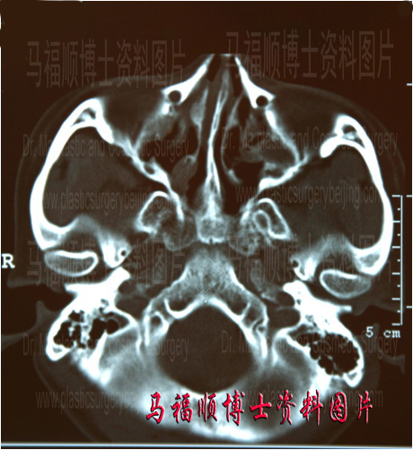 颧骨颧弓术前CT断层