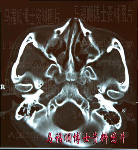 术前模拟颧骨颧弓整形后CT表现