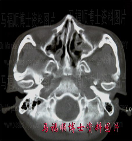颧骨颧弓整形后实际CT断层片