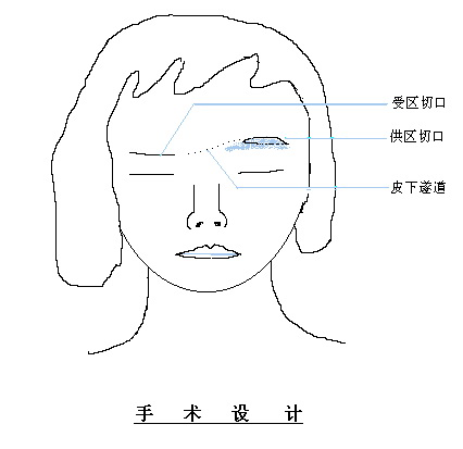 眉毛再造手术设计