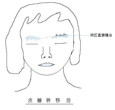 眉毛再造皮瓣转移后