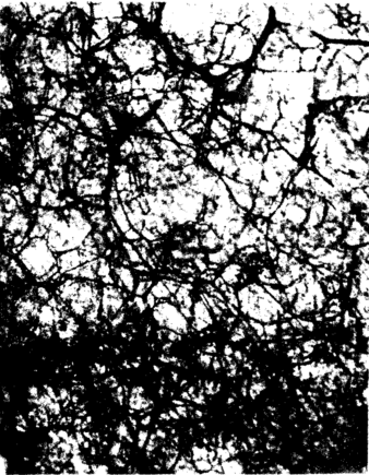 肩峰部位的真皮下血管网