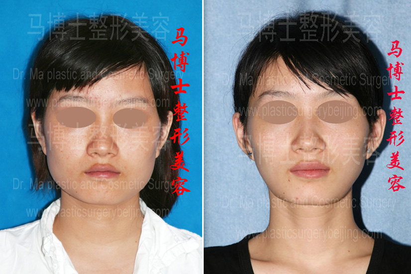 下颌角缩小咬肌部分切除瘦脸整形手术前后对比正面