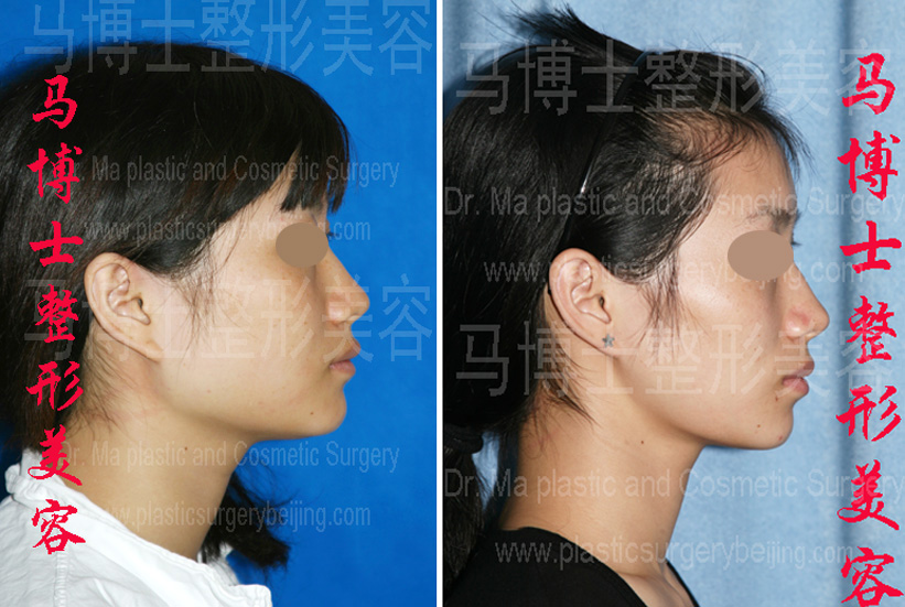 下颌角缩小咬肌部分切除瘦脸整形手术前后对比侧面