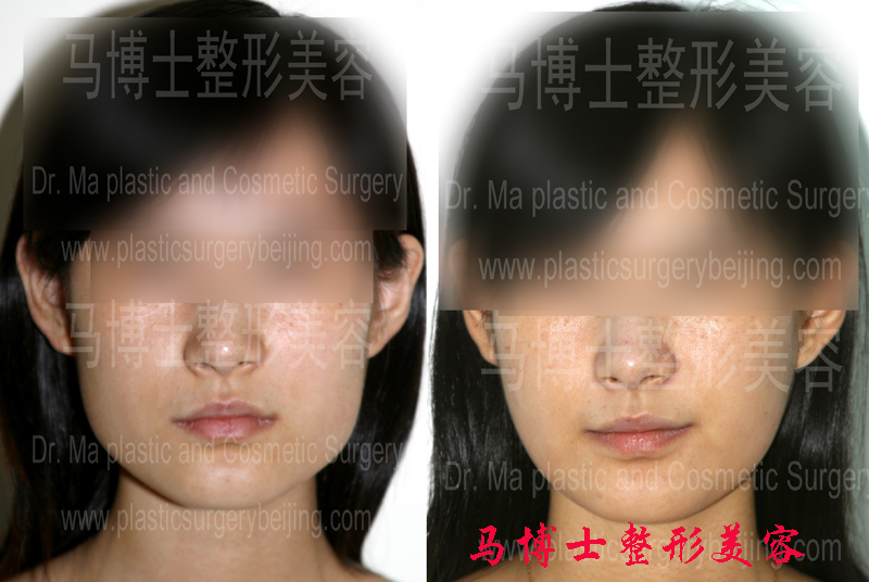 下颌角缩小整形咬肌部分切除手术效果比较正面