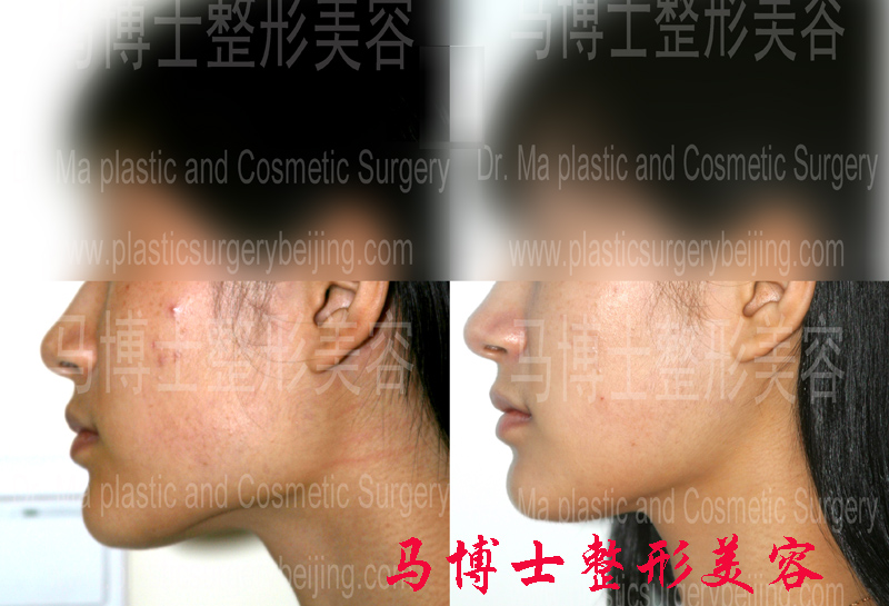 下颌角缩小整形咬肌部分切除手术效果比较侧面