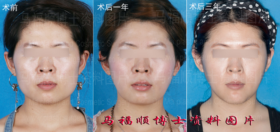 颧骨颧弓下颌骨整形一年及三年