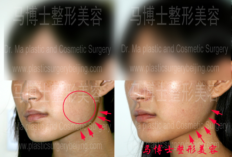 下颌角缩小整形咬肌部分切除手术效果比较45度角