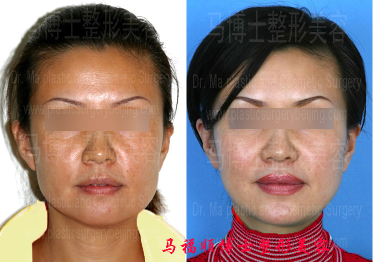 不对称下颌整形术前术后