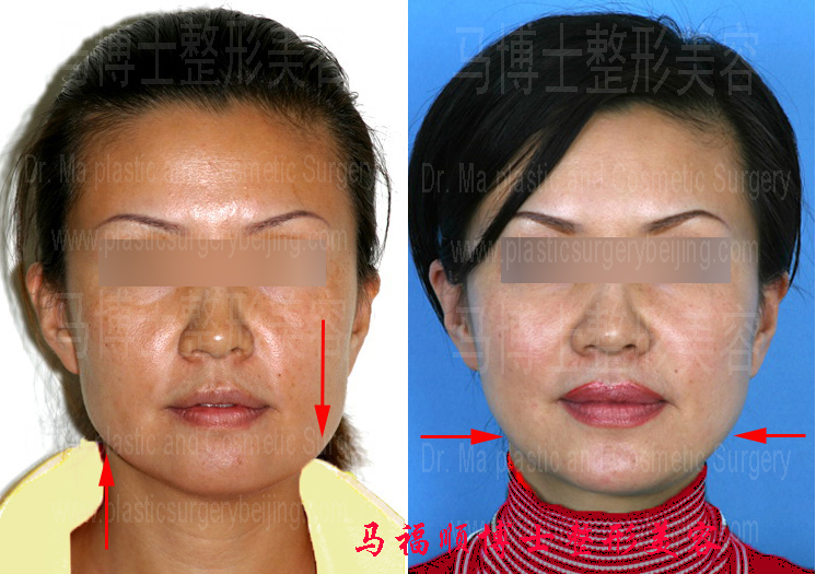 不对称下颌整形术前术后照片分析