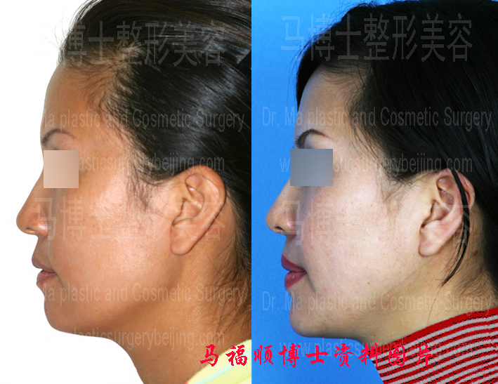 不对称下颌整形手术前后侧位