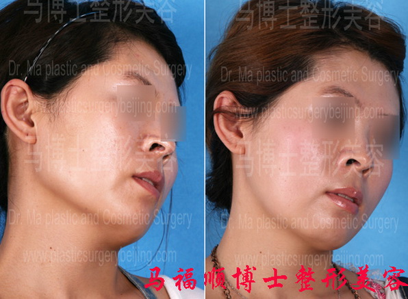 下颌骨及咬肌部分切除后歪头位