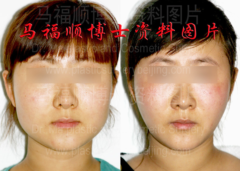 下颌骨雕刻术加咬肌部分切除术 下颌骨雕刻术加咬肌部分切除术