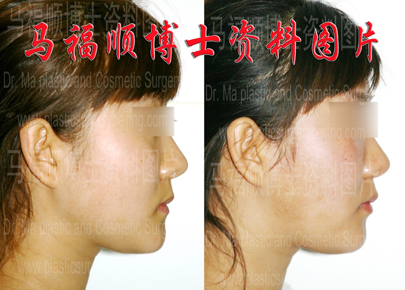 下颌骨雕刻整形及咬肌部分切除 下颌骨雕刻整形及咬肌部分切除