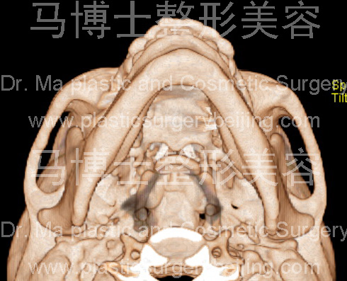 仰头位下颌骨外形