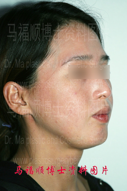 下颌直线截骨所致下颌畸形外观