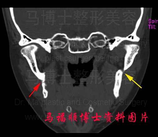 下颌升枝骨折冠状切面CT片