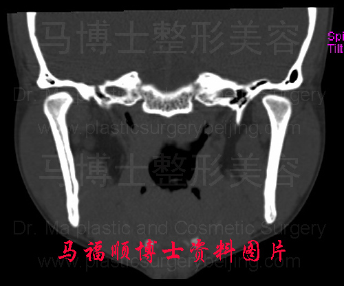 正常下颌升枝冠状切面CT片