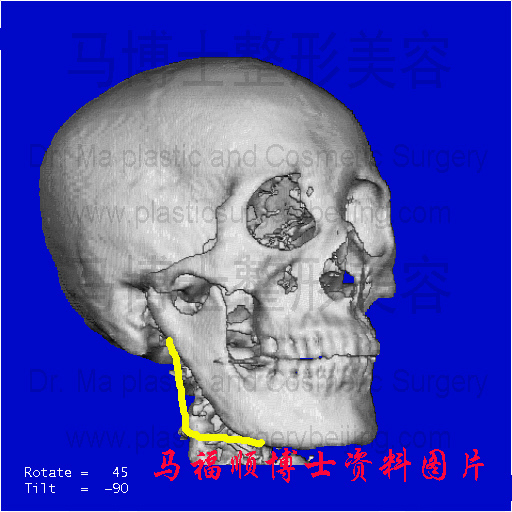 下颌角整形骨骼切除过多