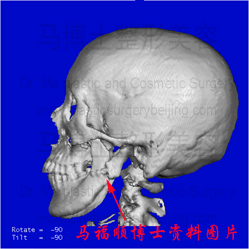 下颌关节突骨折内固定后