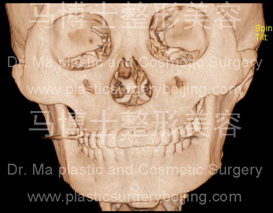 不外翻的下颌角